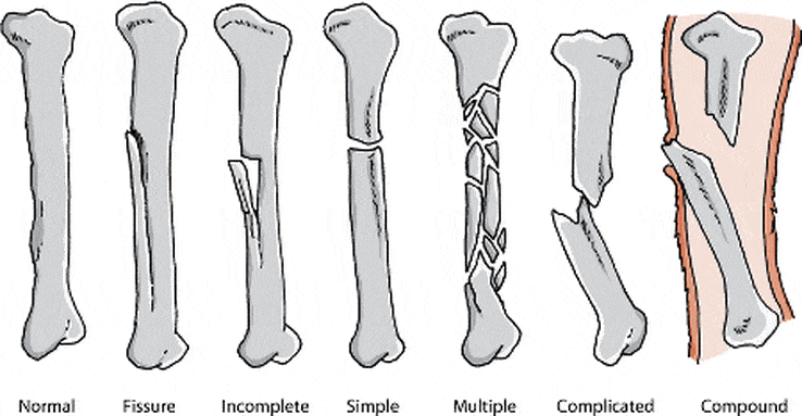 types of broken bones